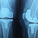 Najlepszą diagnozą jest artroskopia kolana.